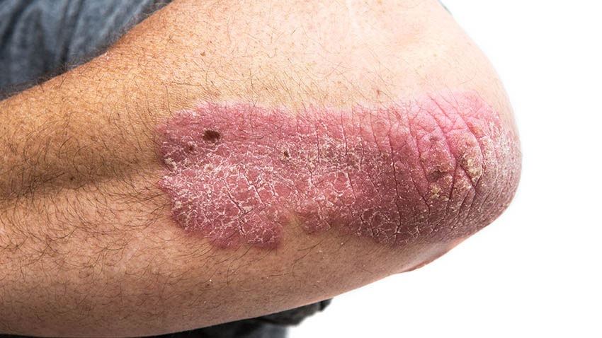 Archive: Clinical photograph of plaque psoriasis on an elbow (Haley Otman, CC BY 3.0). Not the 18 September 2026 EU marketing authorisation, not a Janssen or J&J promotional image, not an ICONIC trial participant identified to this edition, and not a treated-patient outcome photograph for Icotyde.